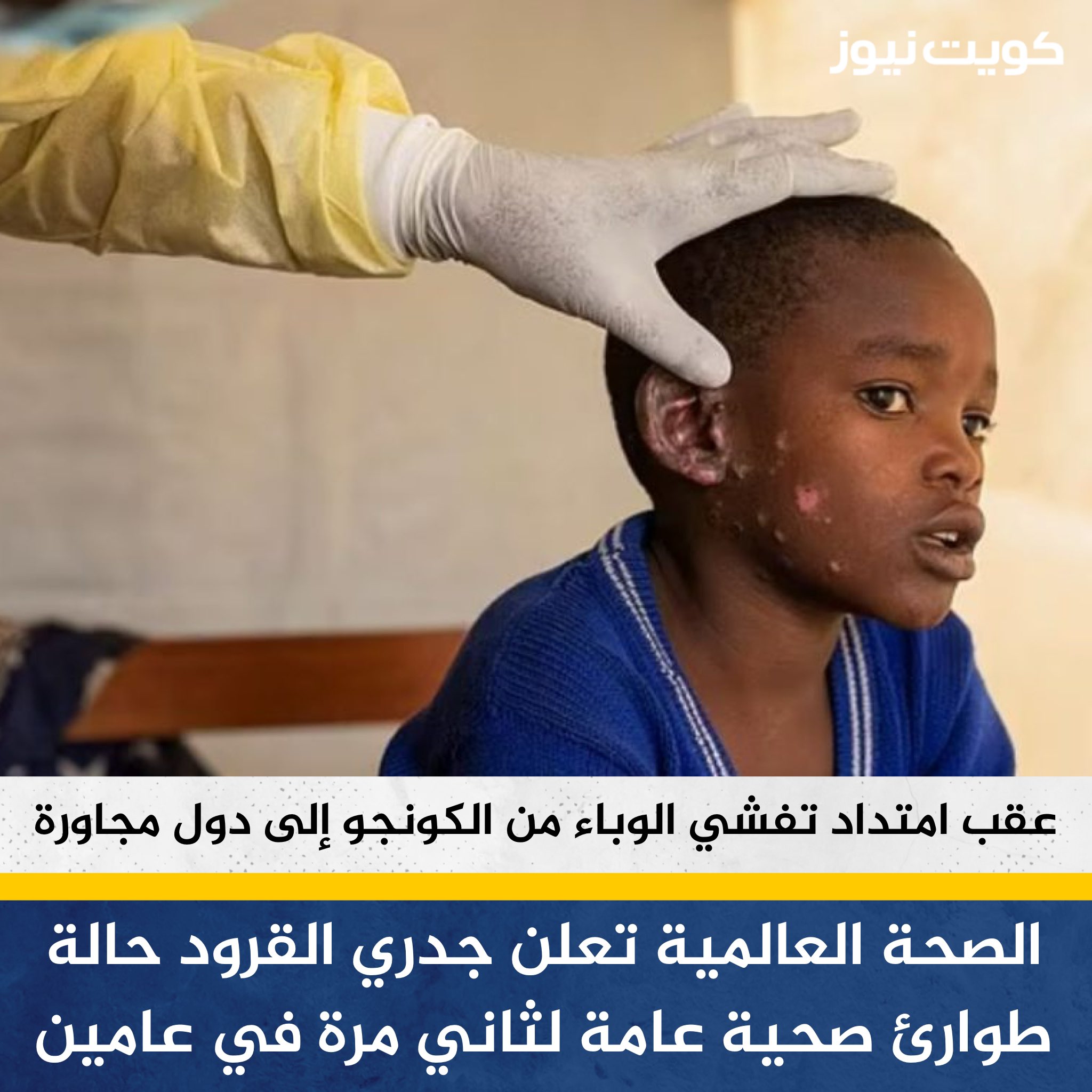 طرق الوقاية من مرض جدري القرود