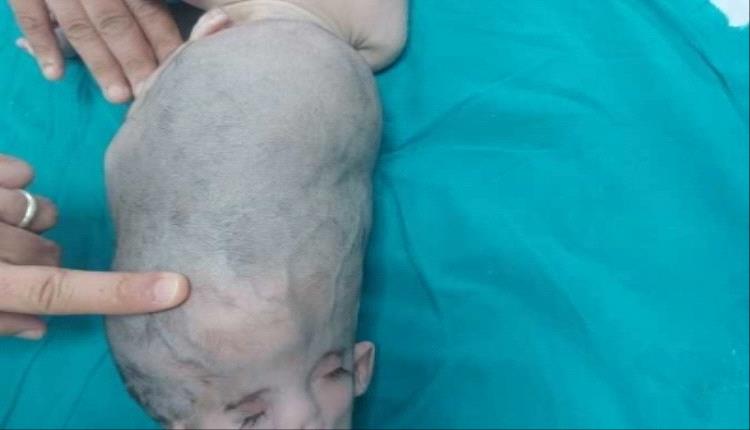 أجريت في 10 ساعات.. تفاصيل أول جراحة فصل توأم ملتصق الرأس 