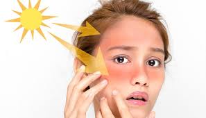 كيفية علاج البشرة من حروق الشمس