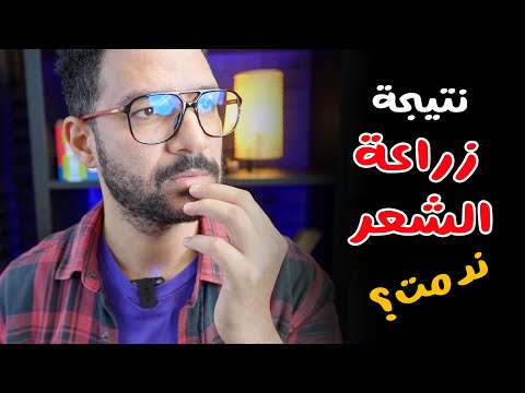 نتيجة زراعة شعري بعد 6 شهور 2026